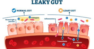 Leaky gut picture