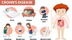 Crohn’s disease symptoms