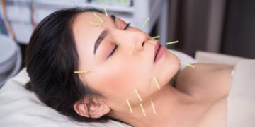 Does Facial Acupuncture Really Work Without Side Effects Of Botox, Laser, And Chemical Peels?